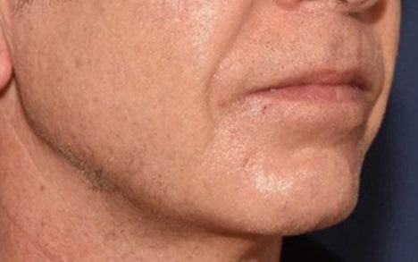 Comblement des rides du visage grâce à l'acide hyaluronique