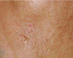 Traitement de la peau au peeling