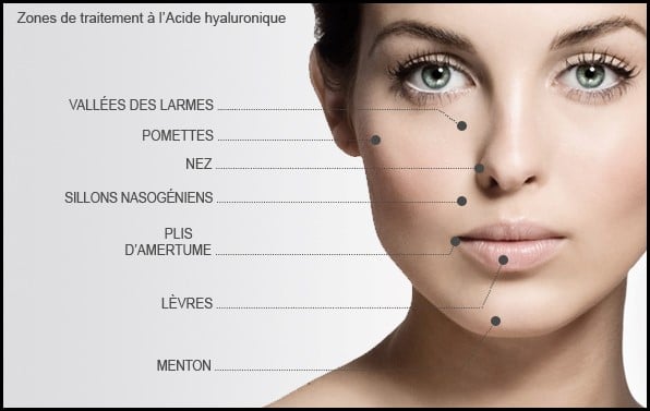 Traitement des différentes zones du visage avec l'acide hyaluronique