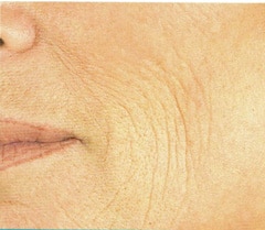 Ridules en bord de bouche