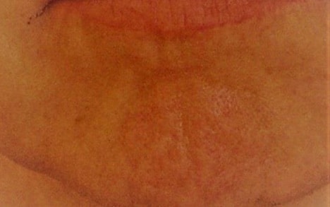 Injection de botox dans le menton