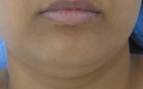 Réduction double menton par cryolipolyse