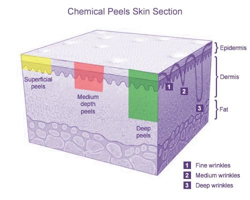 Action du peeling sur les couches de la peau