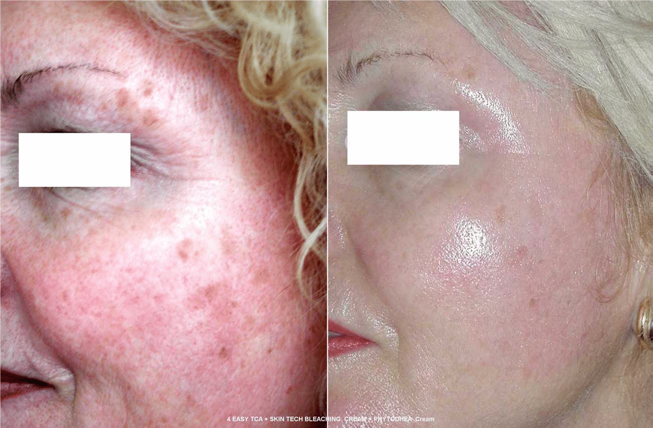 Effacer les taches pigmentaires grâce au peeling moyen