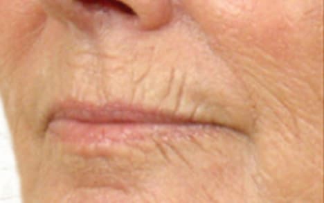 Comblement des rides autour de la bouche avec injection acide hyaluronique