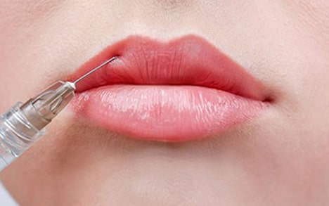 Injection acide hyaluronique dans les lèvres