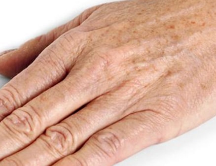 Tâches pigmentaires sur les mains