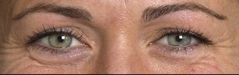 Rides autour des yeux