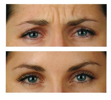 Traitement des rides d'expression par injection de Botox en Belgique